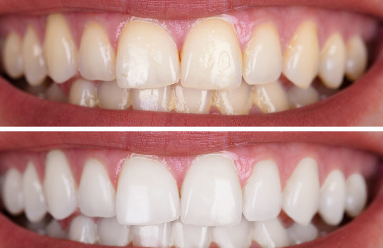 Tooth Whitening using zoom